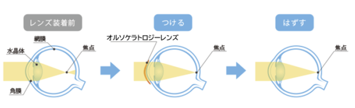オルソケラトロジーとは