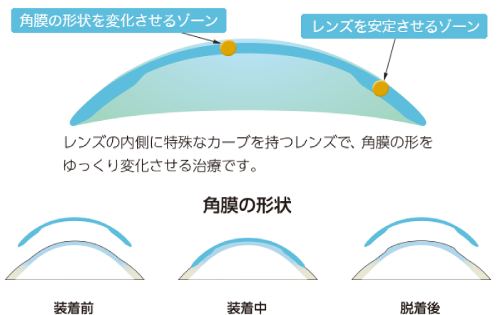 オルソケラトロジーとは